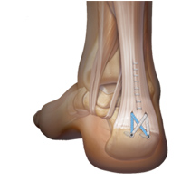 Achilles tendon debridement surgery recovery