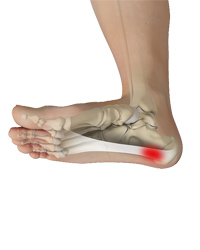 Plantar Fasciitis