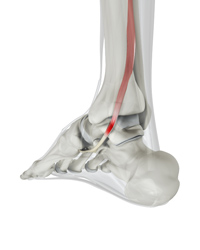 Posterior Tibial Tendon Dysfunction