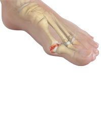 Stiff Big Toe (Hallux Rigidus)