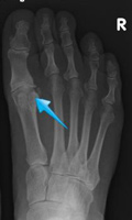 Treatment for Arthritic Big Toe Joints (Hallux Rigidus) - Perth